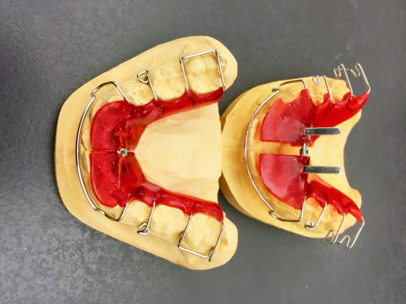 Fabricación de prótesis de ortodoncia